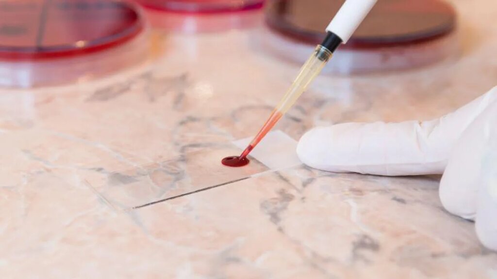 آزمایش قطعات DNA در خون نویدبخش تشخیص ساده و ارزان برای سرطان‌ها است