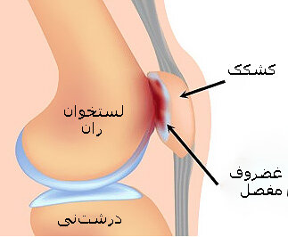 زانوی دوندگان یا کندرومالاسی پاتلا