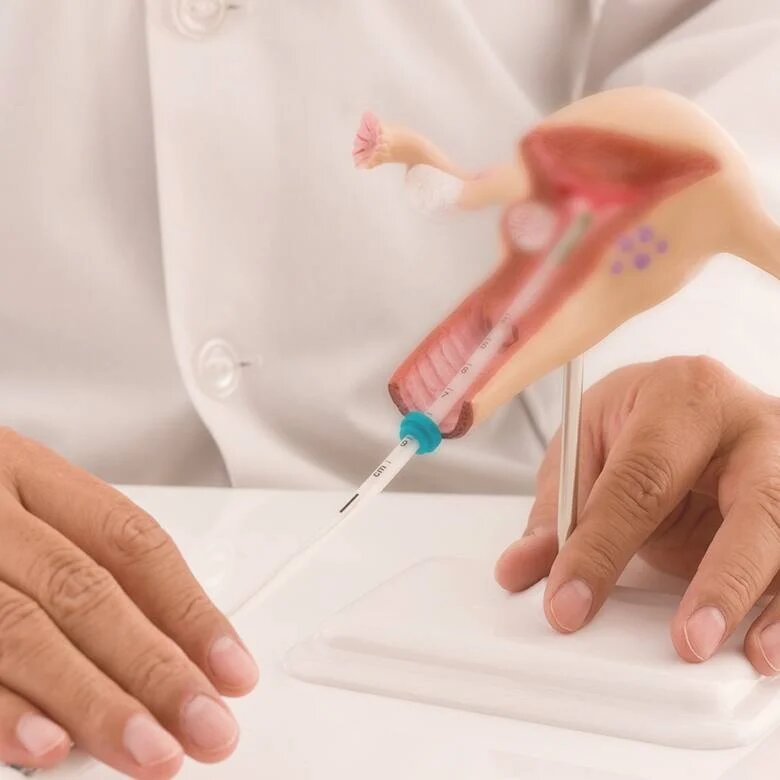 تلقیح داخل رحمی اسپرم: IUI یکی از آسان‌ترین روش‌های کمک به بارداری