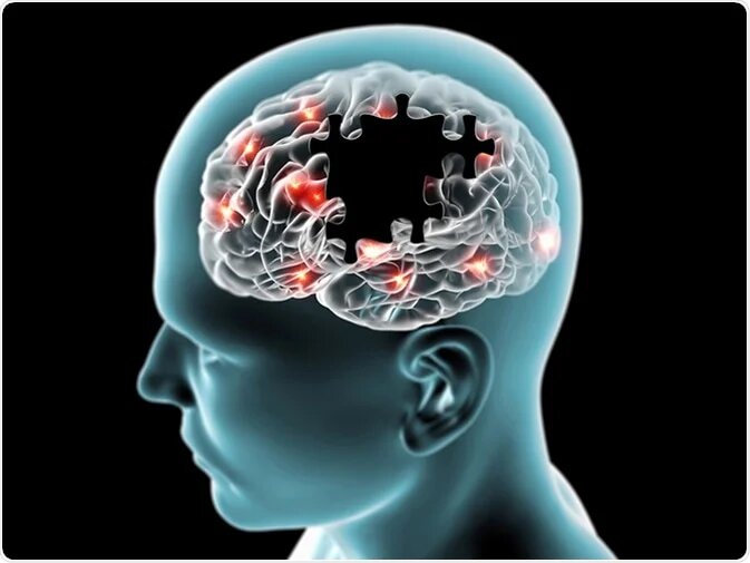 فاکتورهای مشترک سکته مغزی، زوال عقل و افسردگی