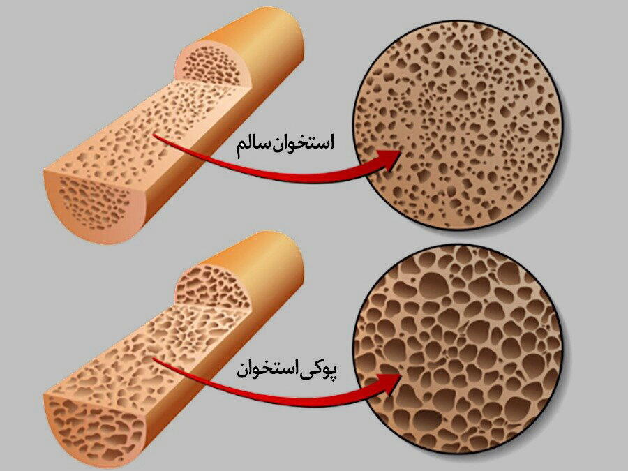 ۲ ویتامین مهم برای قوی شدن استخوان ها و جلوگیری از پوکی استخوان