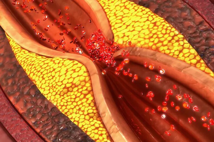 پشت پرده حمله‌های قلبی | آیا می‌توان تجمع پلاک‌های خطرناک را کاهش داد؟